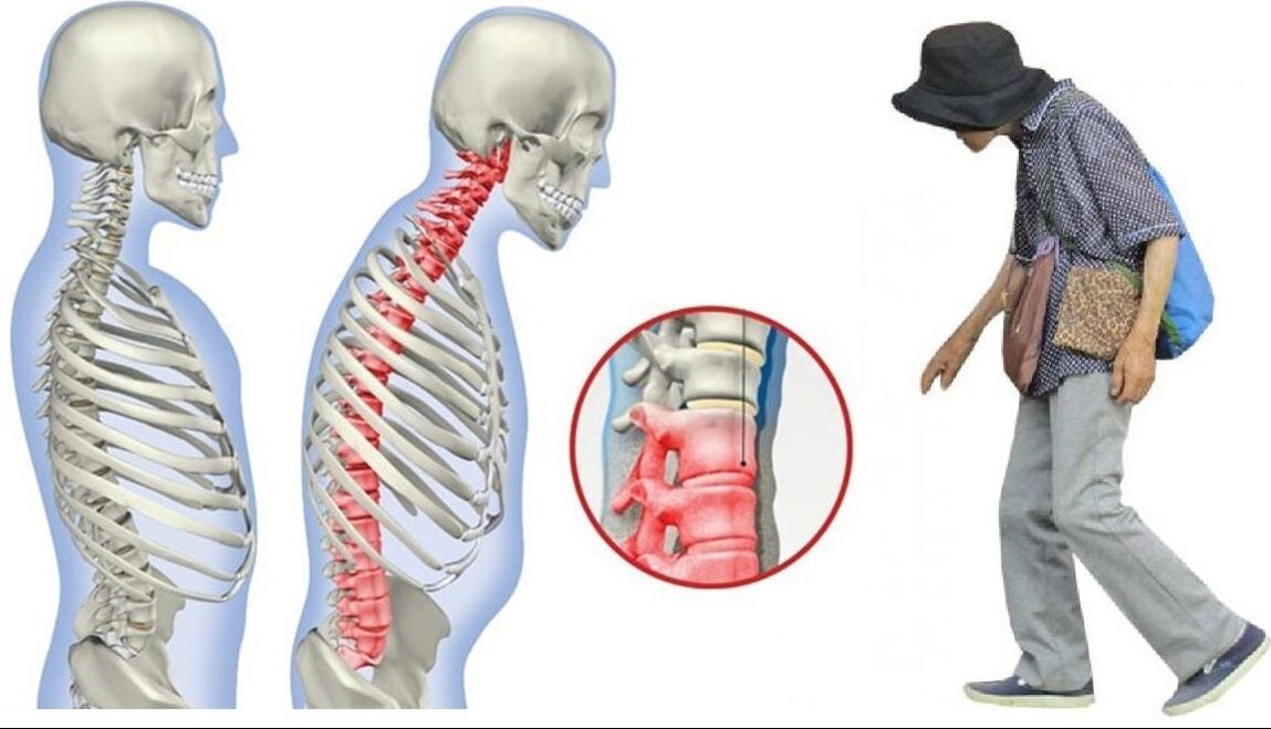 Réckschmerzen wéinst Spondylitis ankyloséierend