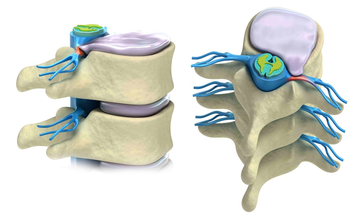 beschiedegt Spinal Disc