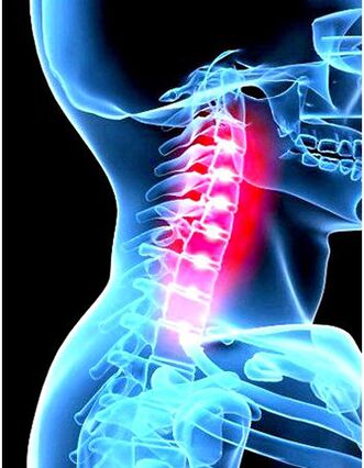 Klinesch Bild vun Osteochondrosis